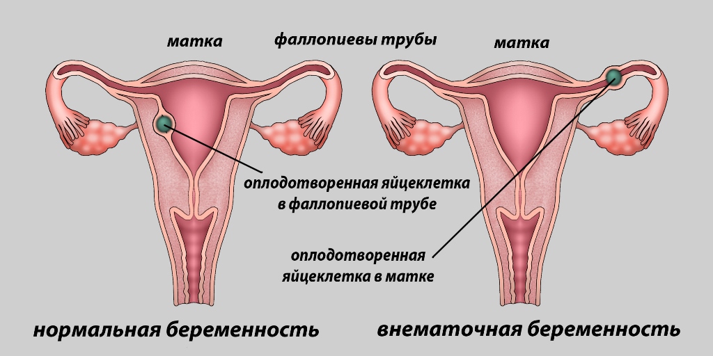 Внематочная беременность