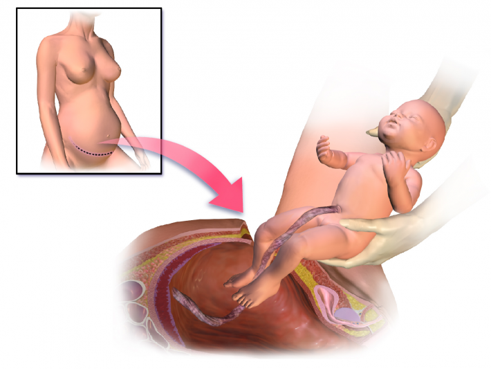 Кесарево сечение предполагает хирургическое изъятие плода при отсутствии возможности естественных родов