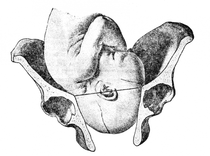 При узком тазе матери и крупном черепе ребенка необходимо кесарево сечение